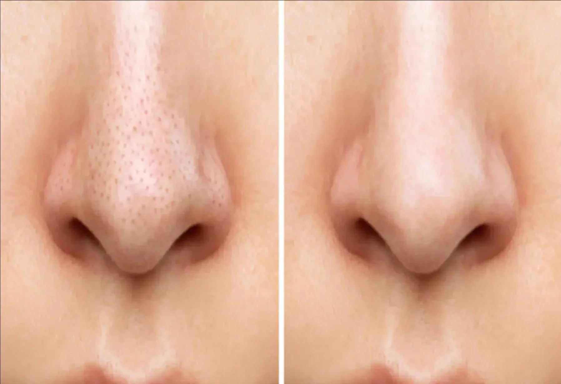 Home remedies to remove blackheads: ब्लैकहेड्स को जड़ से खत्म करें! नाक के काले धब्बों को हटाने के 4 आसान घरेलू नुस्खे, आजमाएं और देखें कमाल!
