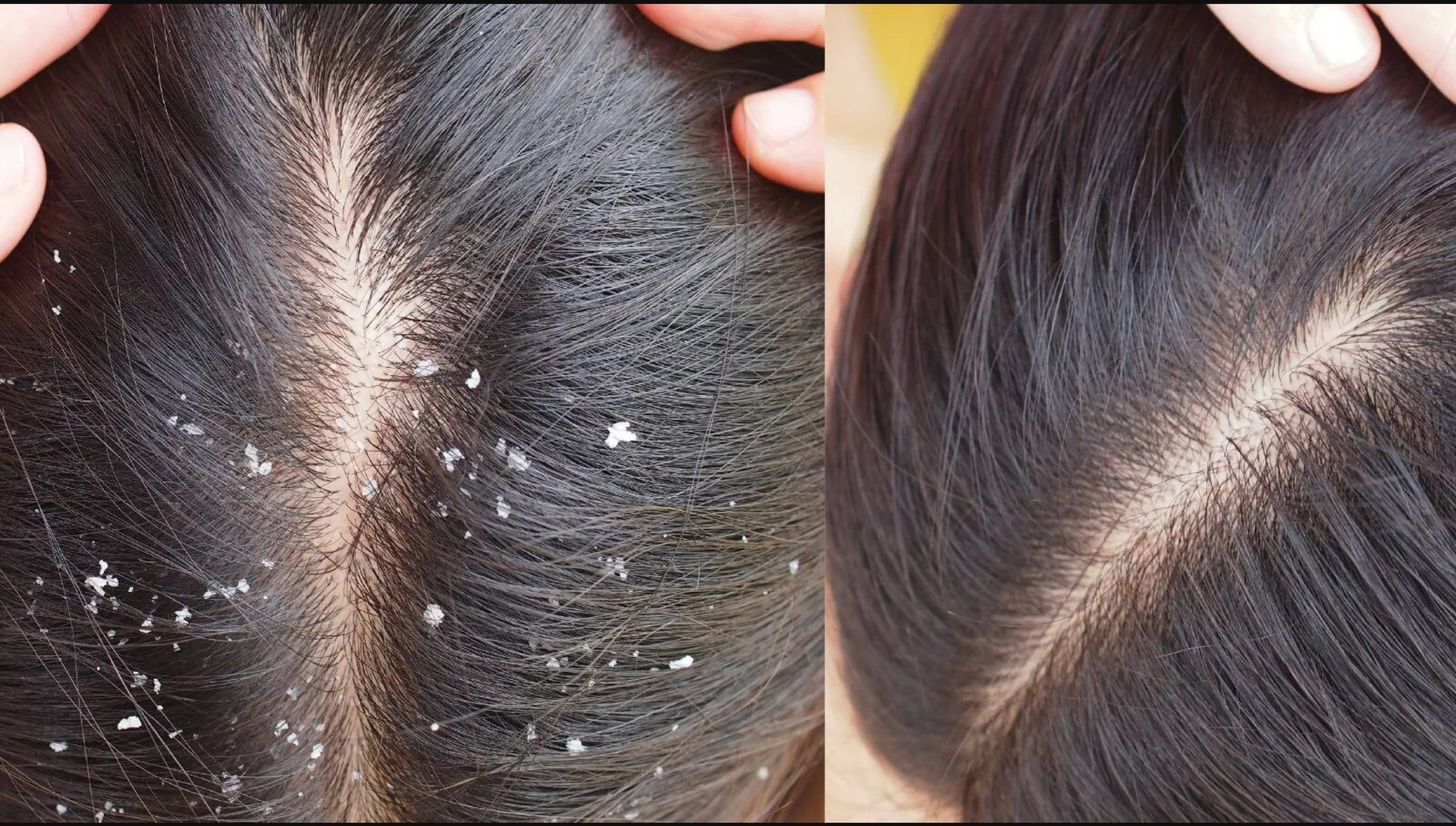 Homemade remedy for dandruff in Hindi: डैंड्रफ को कहें हमेशा के लिए बाय-बाय! अपनाएं ये 5 देसी नुस्खे और पाएं साफ़-सुथरे बाल, वो भी बिना शैंपू के